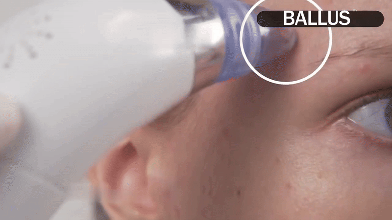 Pore Cleaning Device – Clear Skin, No Filters Needed!