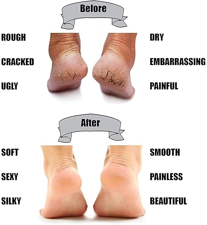 Anti Foot Crack – Say Goodbye to Dry, Cracked Feet!